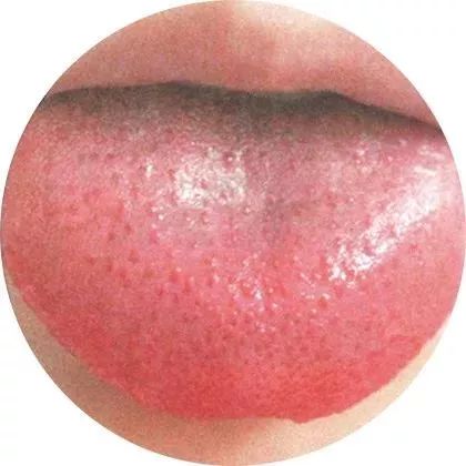 舌苔:少 舌质:较红 舌体:舌乳头明显 此舌象提示患者肝肾不足,渐以化