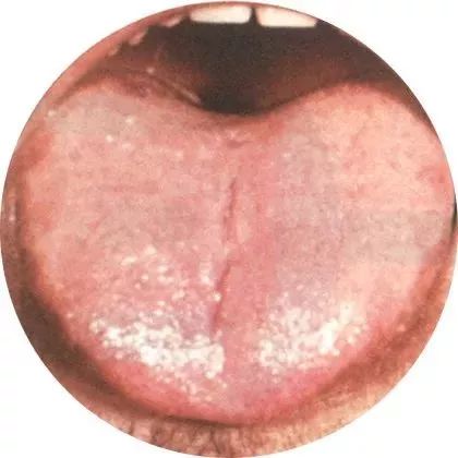 最全的舌诊图谱_舌苔