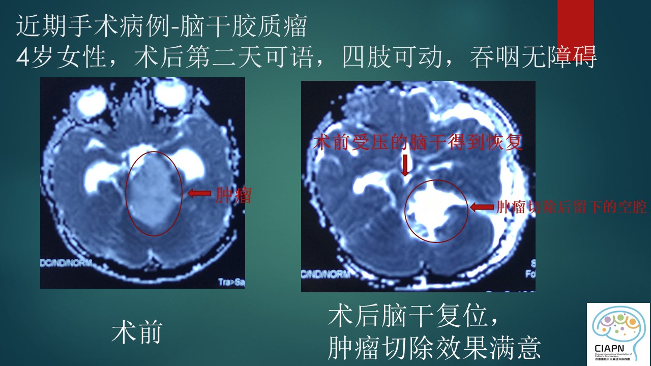 原创儿童脑干胶质瘤能够手术吗