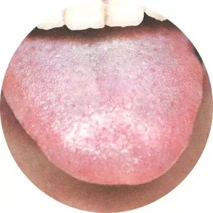 此舌象患者或有消化不良,四肢乏力,大便不成形等症状.