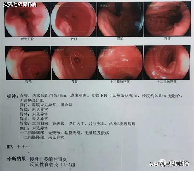 后经胃镜检查发现"食管裂孔疝,反流性食管炎.
