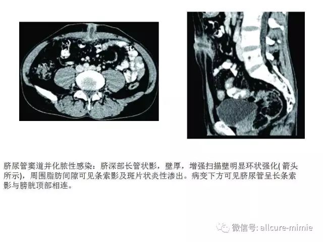 正常脐尿管及脐尿管病变的影像学表现