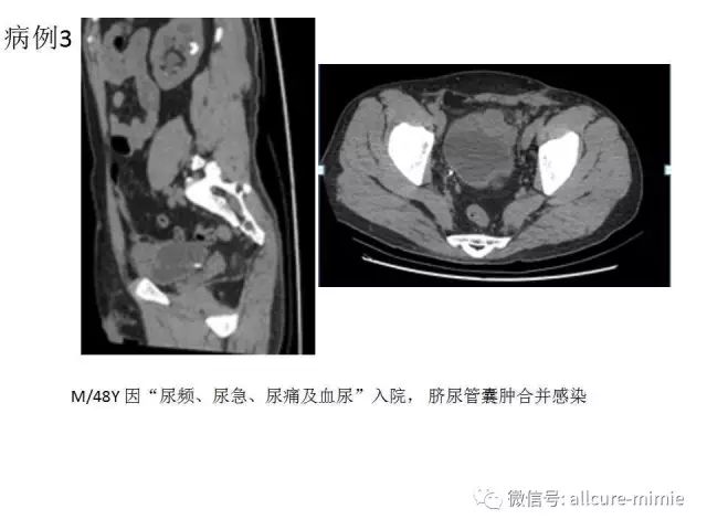 正常脐尿管及脐尿管病变的影像学表现