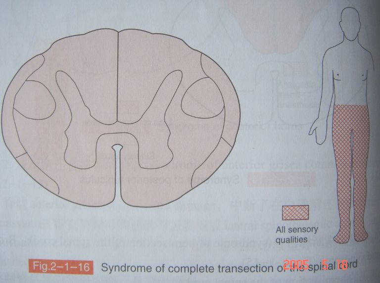 深感觉丧失及上运动神经元瘫痪对侧:痛温觉丧失脊髓半切综合征后索型