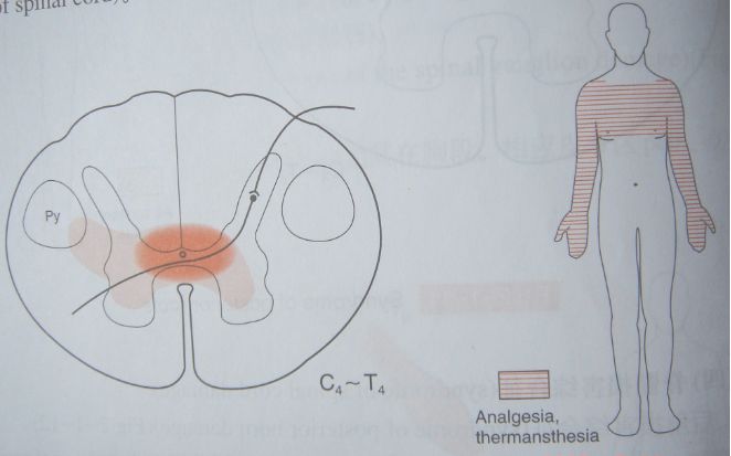触觉及深感觉仍保留;解剖:脊髓前连合是两侧脊髓丘脑束的交叉纤维所在