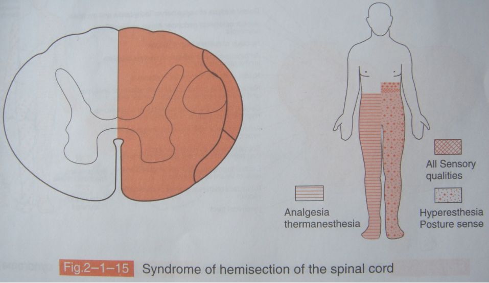 同侧:深感觉丧失及上运动神经元瘫痪对侧:痛温觉丧失脊髓半切综合征后