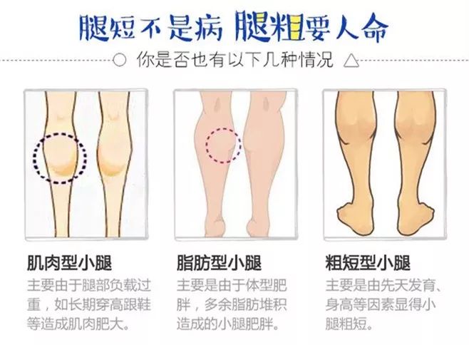如何判断自己是哪种腿粗类型 7612406d92a543ae840f8658b796a1a0.jpeg