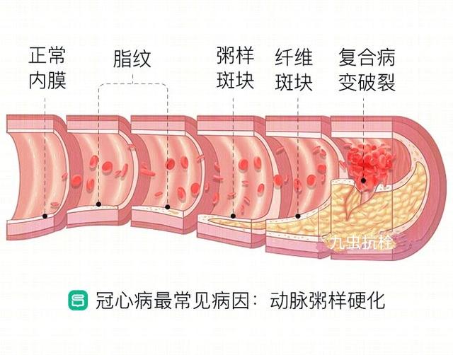 心肌梗塞搭桥的原理_3、讨论   溶栓、经皮冠状动脉介入治疗(pci)、冠状动脉搭桥术等方法广泛