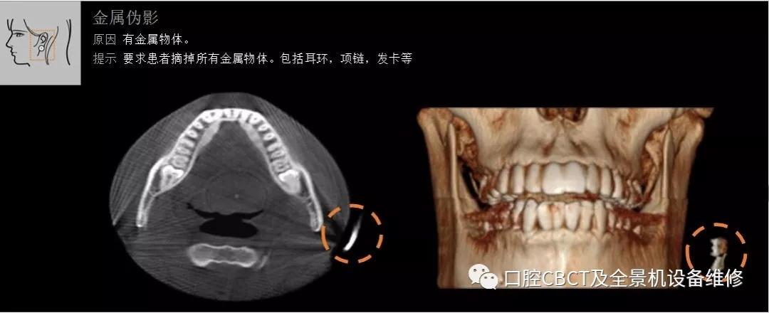 拍口腔全景片cbct之前需要注意什么