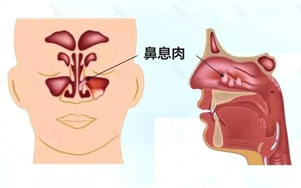 鼻子不通气竟然是鼻息肉在"作祟"