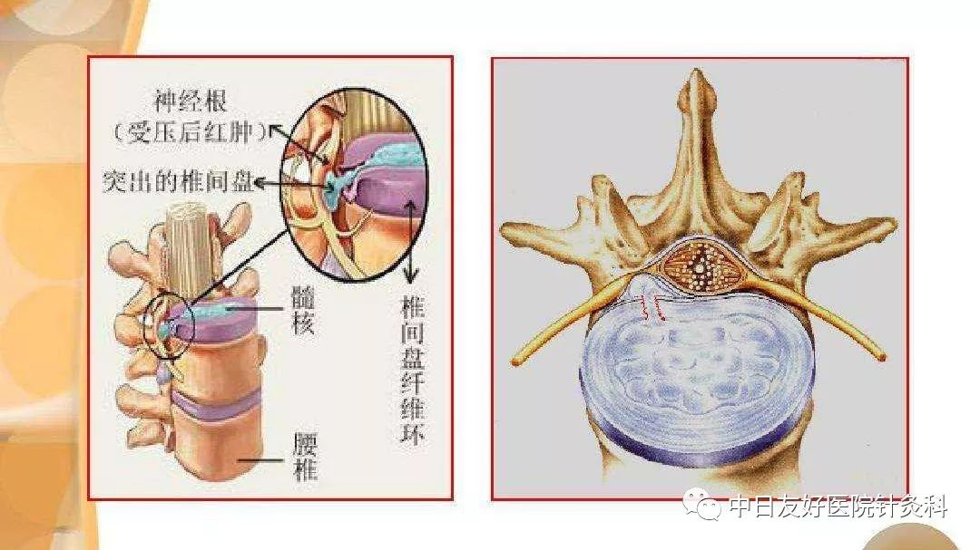 头痛,您查颈椎了吗?