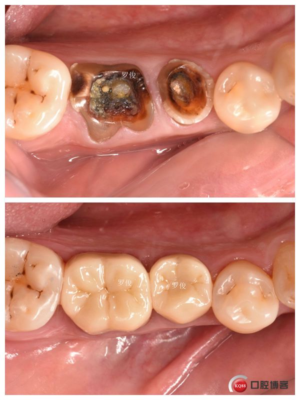 后牙残冠修复之髓室底修补