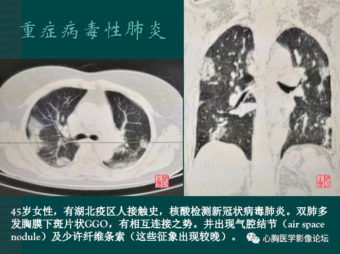 病毒性肺炎概念与ct表现