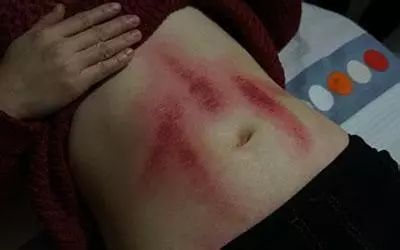 女人经常刮痧,原来有这么多的好处!