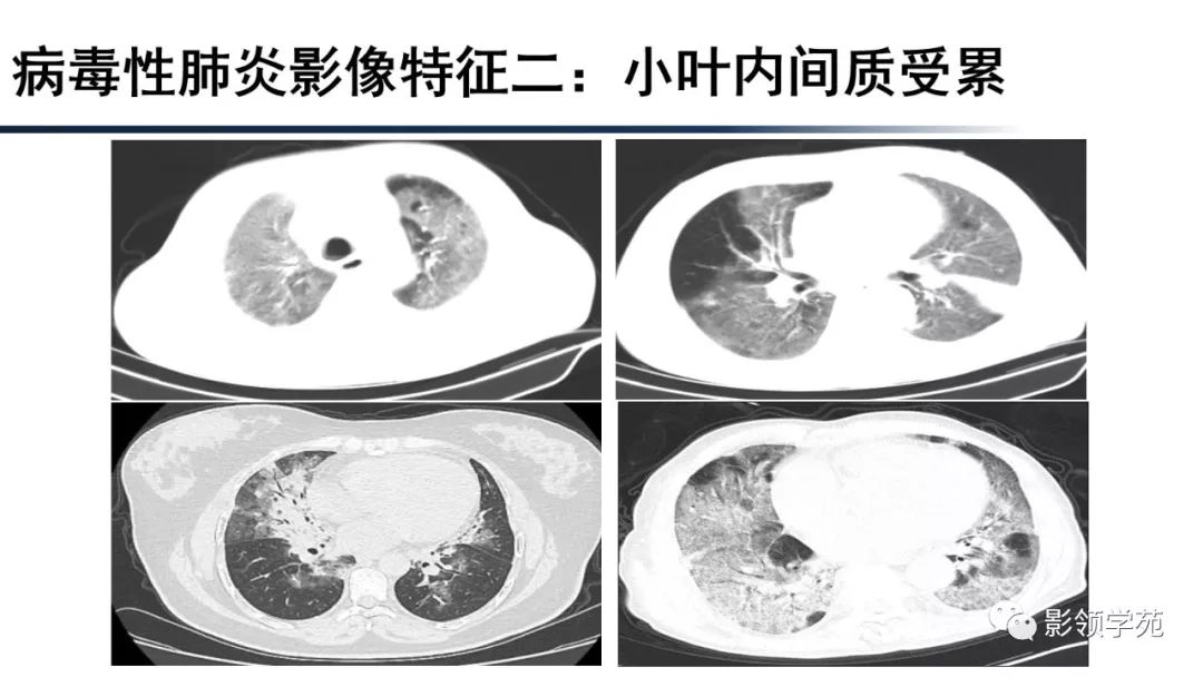 【经典】病毒性肺炎及2019-ncov影像诊断思路