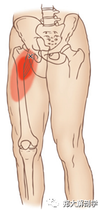大腿肌肉的扳机点与拉伸_膝关节