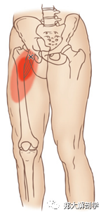 大腿肌肉的扳机点与拉伸