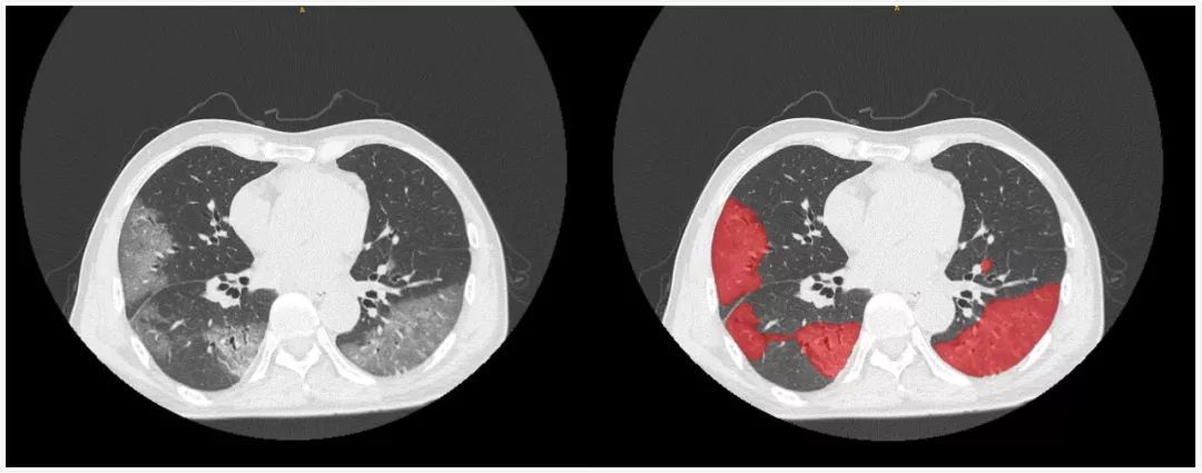 新型冠状病毒肺炎胸部ct影像(左)与肺炎感染区域的分割图像(右)