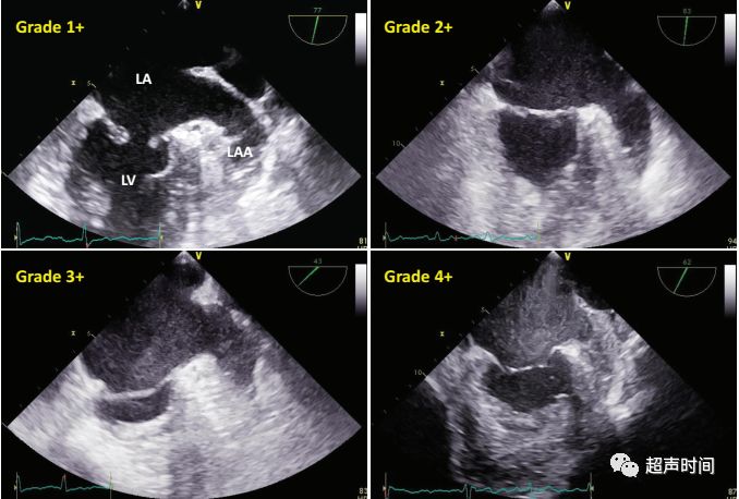 4:表1 左房/左心耳自发超声显影的分级根据声像图表现的差异,sec 可