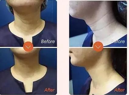 红翻天的嗨体去颈纹利弊、嗨体去颈纹维持多久