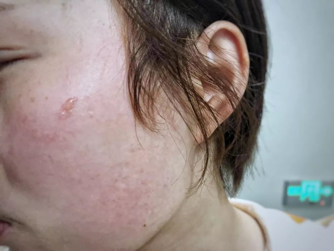 草莓舌是什么样的有图片吗 dc7e5880b3614b44ae379c3bea7dd870.png