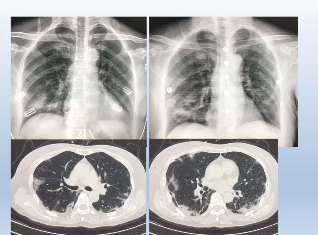【案例分析】新冠状病毒肺炎病例影像总结