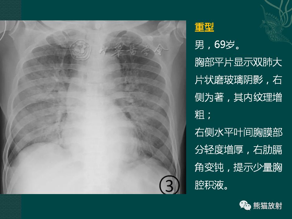 规范与共识丨新冠肺炎的放射学诊断:中放专家推荐意见