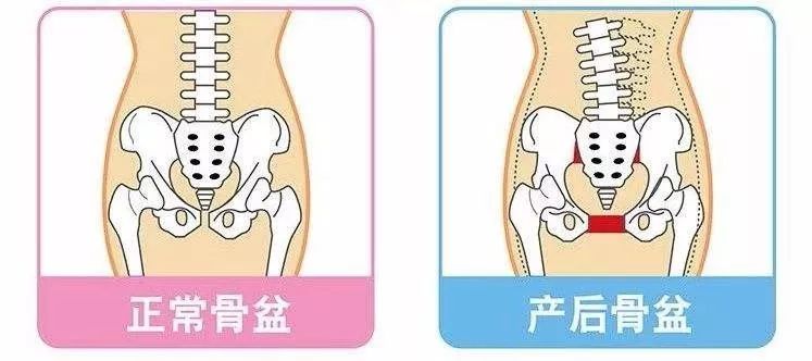 骨盆修复的原理_仪器骨盆修复和徒手的哪个更适合 看完这篇文章你就知道了