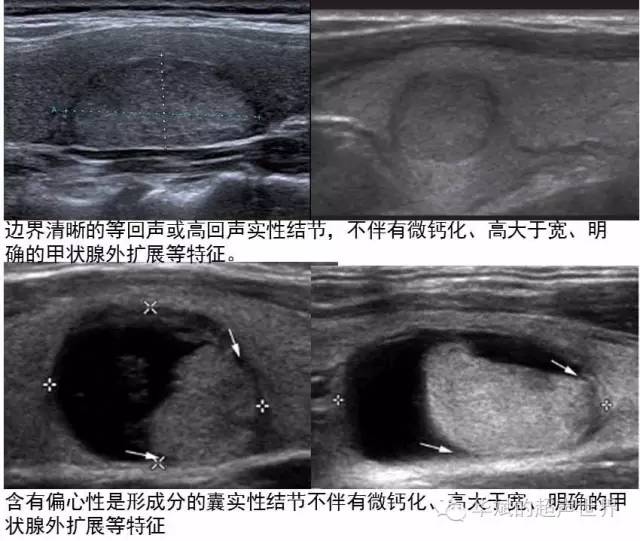 视频:甲状腺结节的超声诊断思路