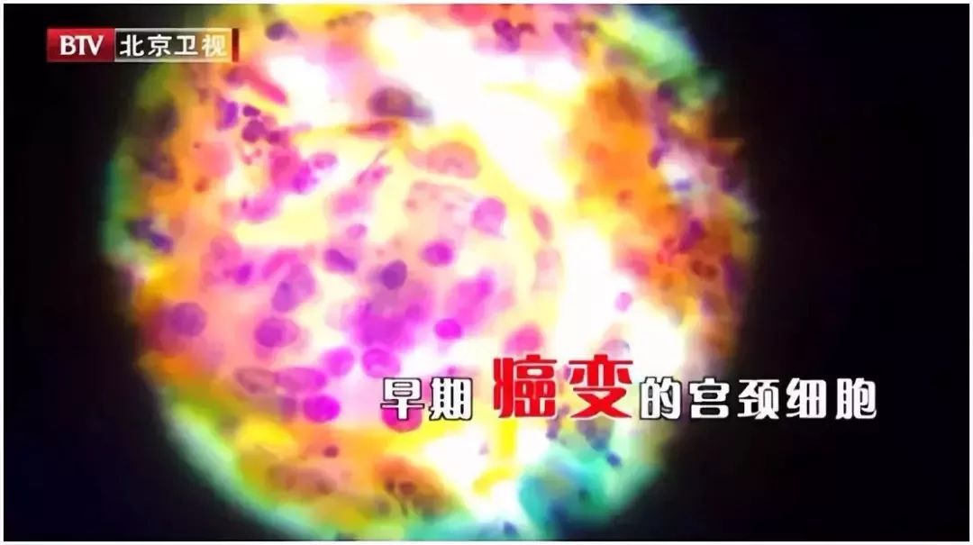 hpv病毒是什么引来的 e1920b8419314c9c944613c3eb0a2fb0.jpeg