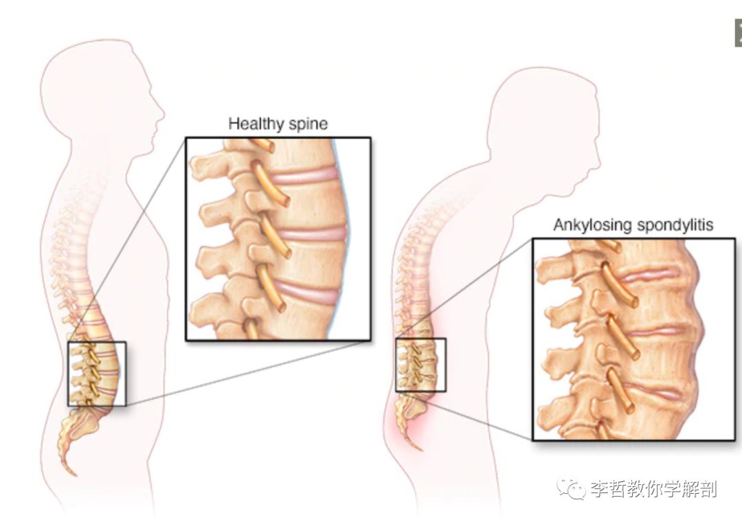 什么是强直性脊柱炎 炎症