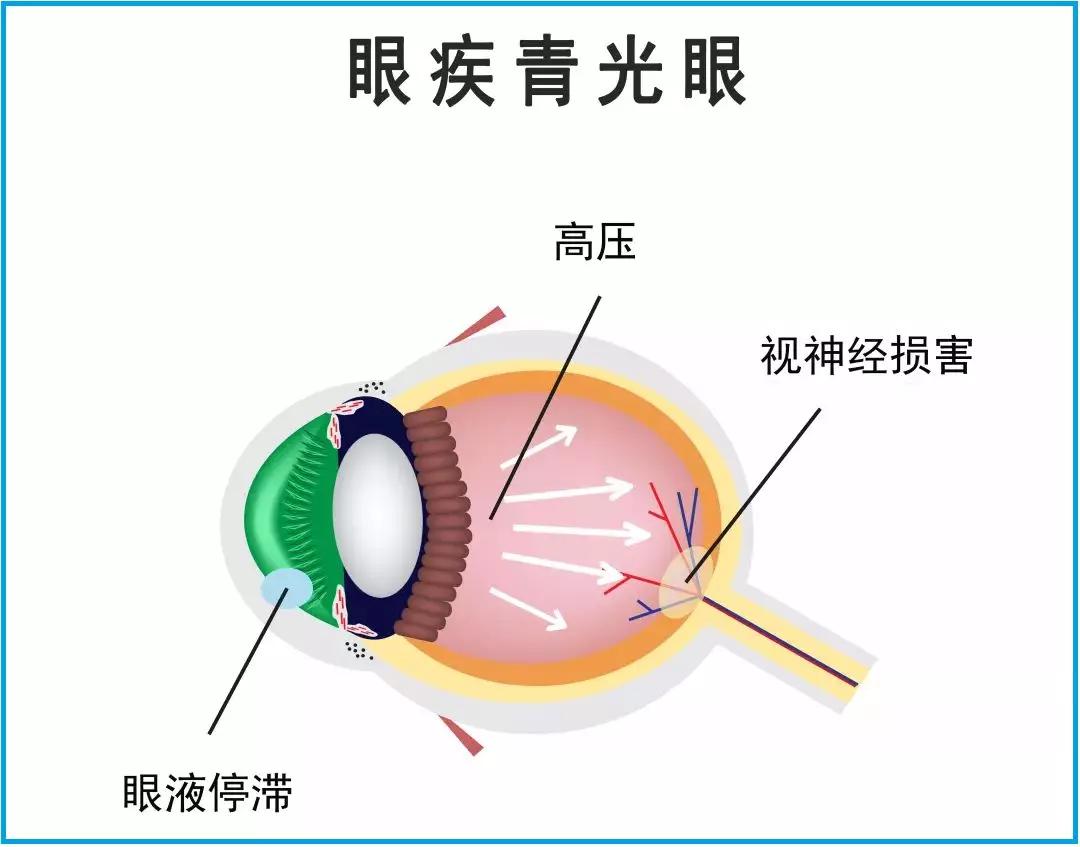 疫情期间在家千万别熬夜玩手机易诱发急性青光眼