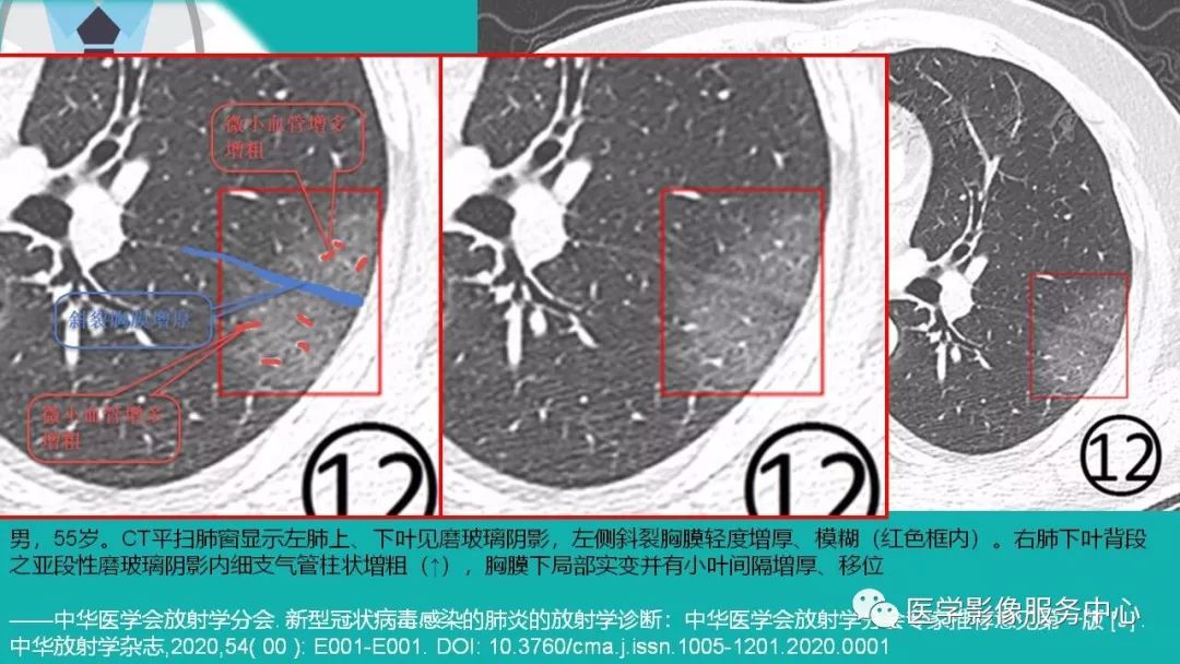 抓住要害丨用三个字概括新冠肺炎的特征性影像学