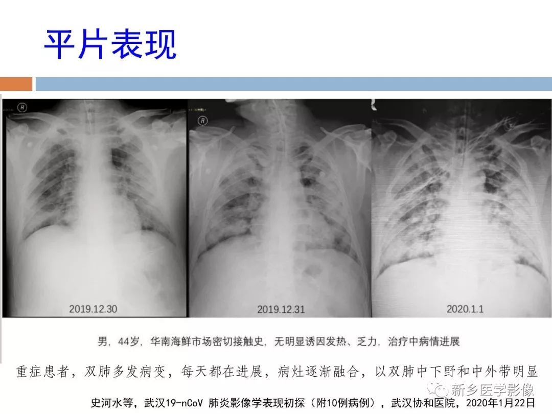 【详细解读】新冠状病毒肺炎x线ct诊断和鉴别诊断