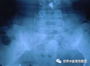 骶椎疼怎么办