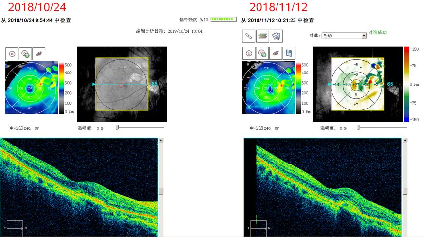 oct黄斑变化分析