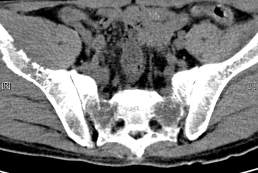 pet-ct:右侧髂骨骨质破坏伴软组织肿块,fdg代谢增高,全身骨骼多发fdg