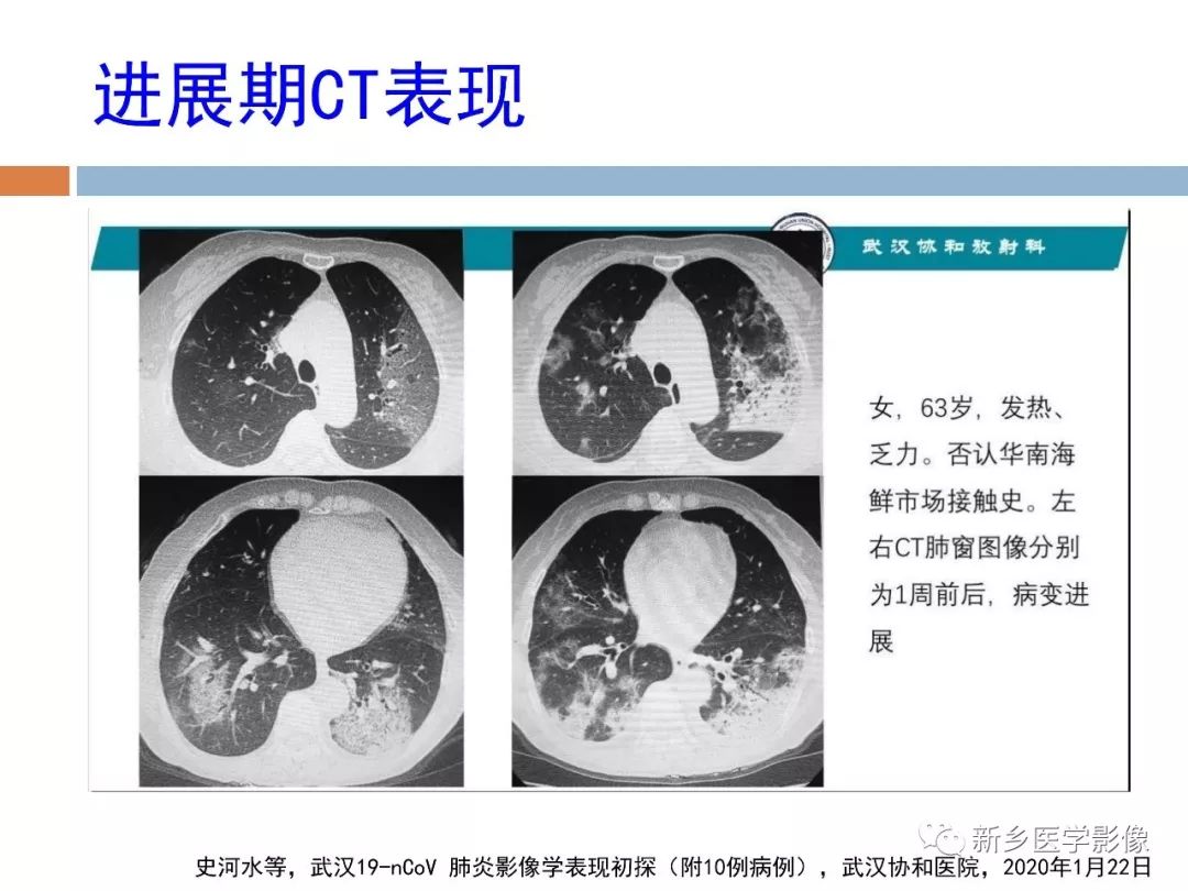 详细解读新冠状病毒肺炎x线ct诊断和鉴别诊断