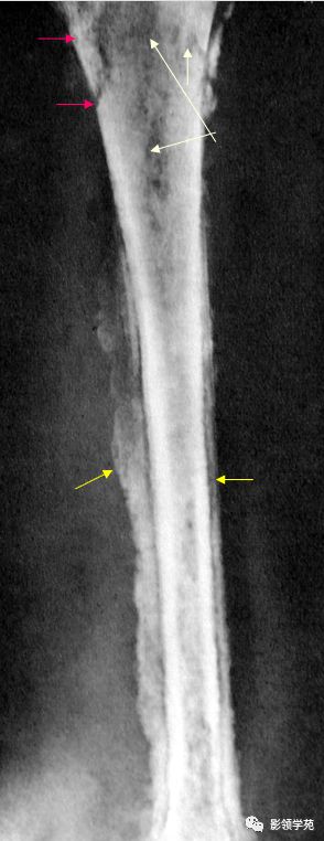 箭头)虫蚀样骨皮质坏,中断(黄箭头)条形,花边状骨膜增生化脓性关节炎