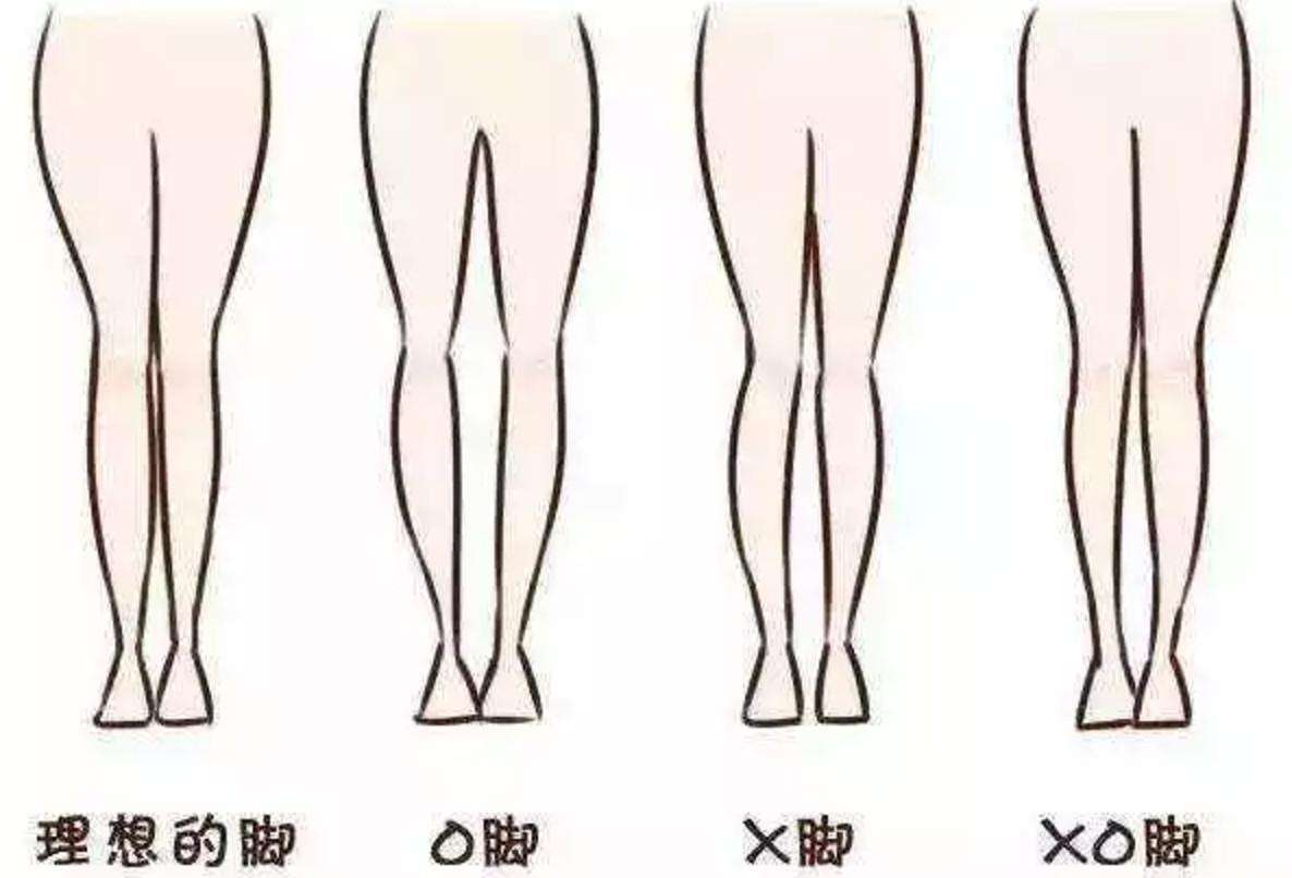 佝偻病当道而你却浑然不知留下后遗症后患无穷