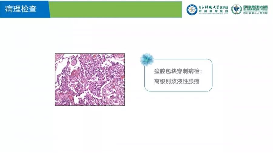 经盆腔包块穿刺,病理确诊为:高级别浆液性腺癌,故诊断为:卵巢高级别