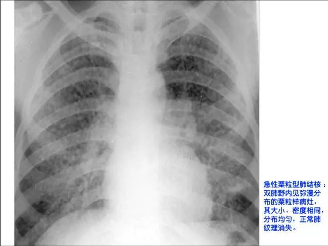 照片名称:急性粟粒型肺结核照片名称:干酪性肺炎照片名称:左胸腔包裹