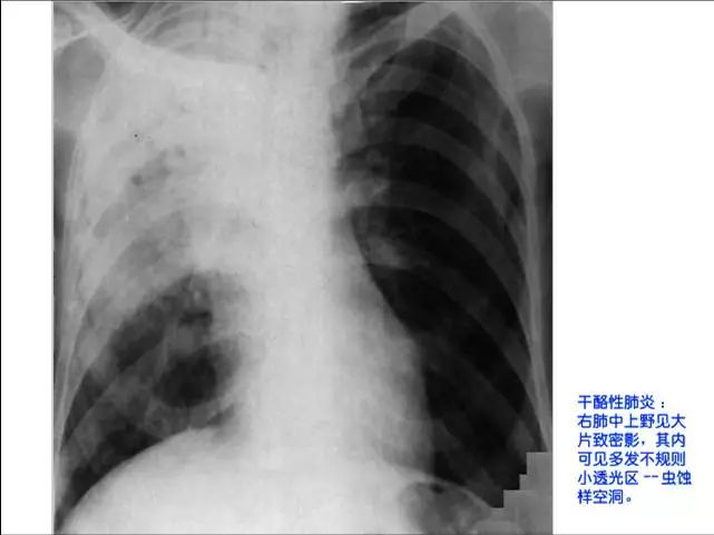 照片名称:干酪性肺炎