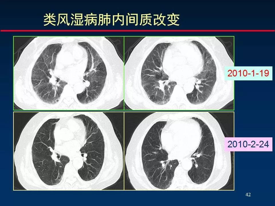 师说丨正确判读肺间质改变的基本ct表现