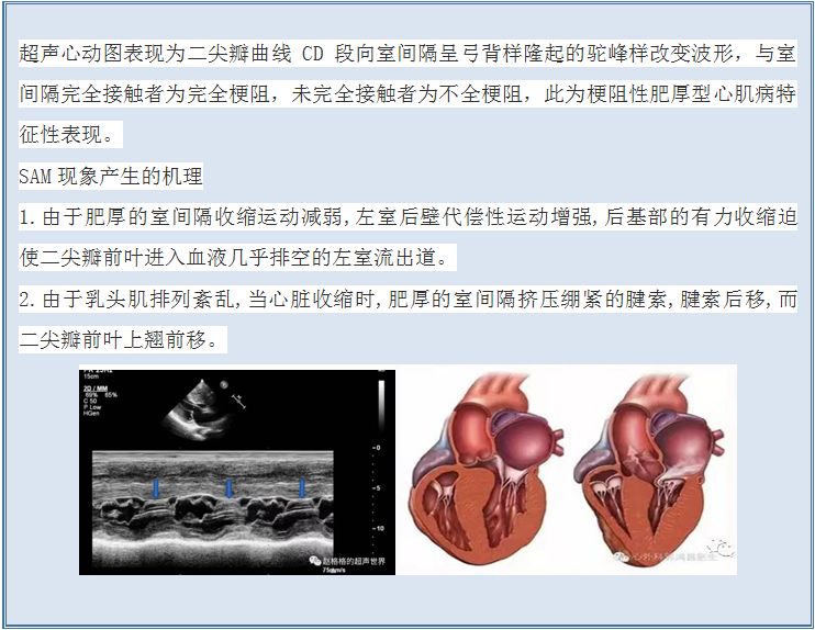 目前,梗阻性肥厚型心肌病(hocm)的药物治疗有——β受体阻断药,维拉