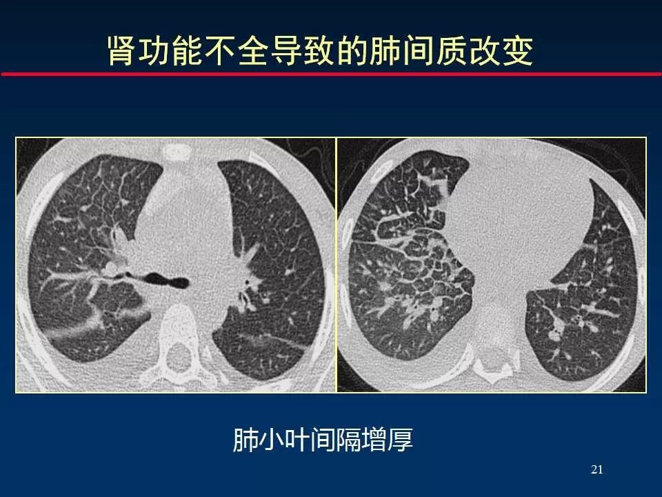 师说丨正确判读肺间质改变的基本ct表现