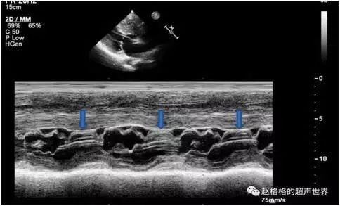超声心动图 sam征小知识