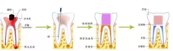 虫牙裂了一半怎么办