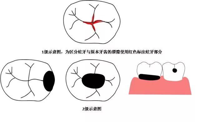 虫牙裂了一半怎么办