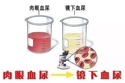 发现自己有血尿怎么办?这1个指标能筛查